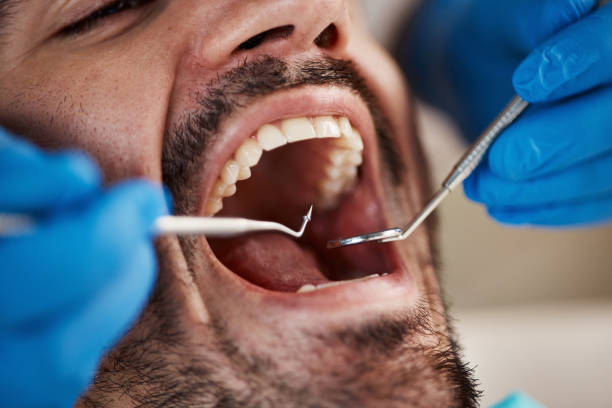 Best Emergency Dental Care for Broken or Chipped Teeth in Leadwood, MO